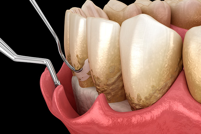 Ein 3D-Rendering zeigt die Behandlung von Parodontitis an der Grenze bis unterhalb des Zahnfleisches